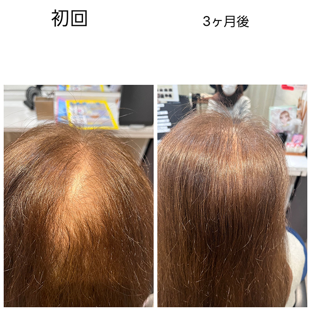 育毛促進ベーシックメニュー