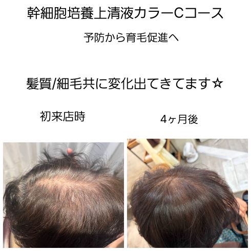 幹細胞カラーエステ soiris