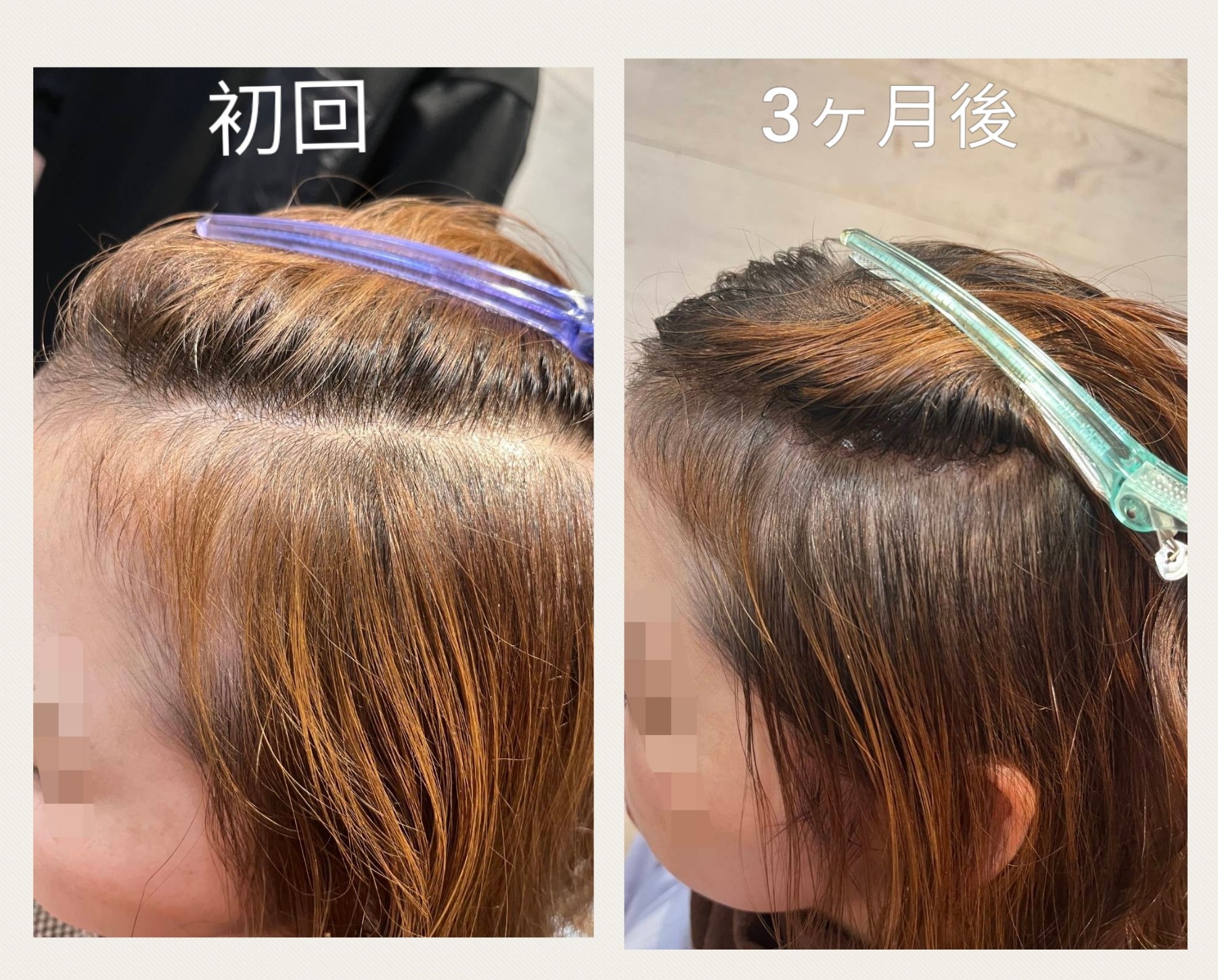 育毛促進ベーシックメニュー