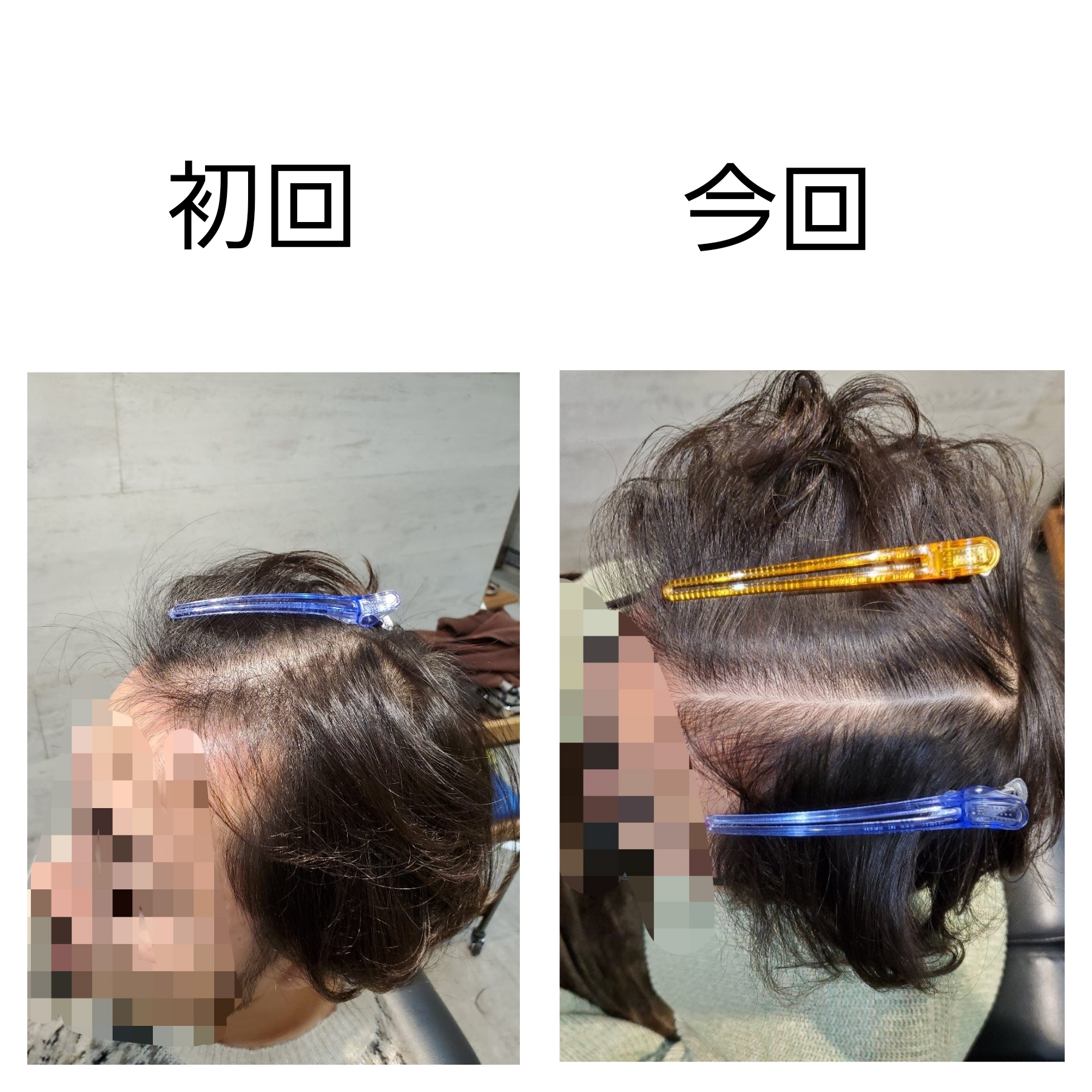 育毛アドバンスメニュー