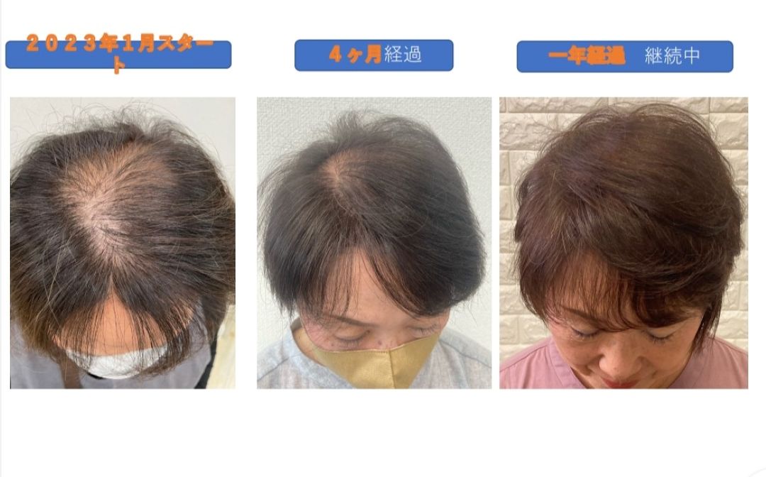 毛幹細胞ヘッドスパ(育毛専用ヘッドスパ)