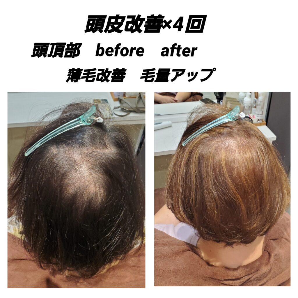 つむじ周りの髪の毛も、薄毛改善　発毛×育毛していきます(^-^)