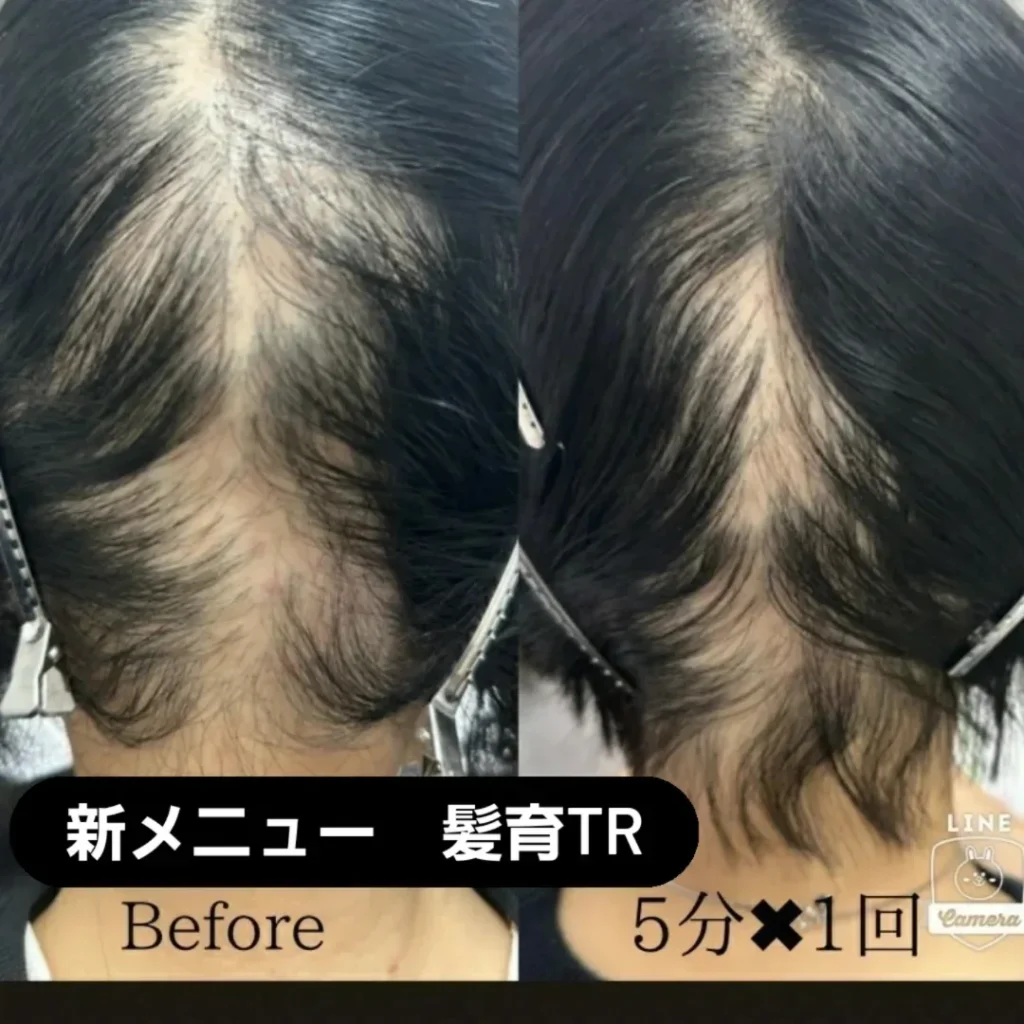 コロナウィルス脱毛はなおりますか…？