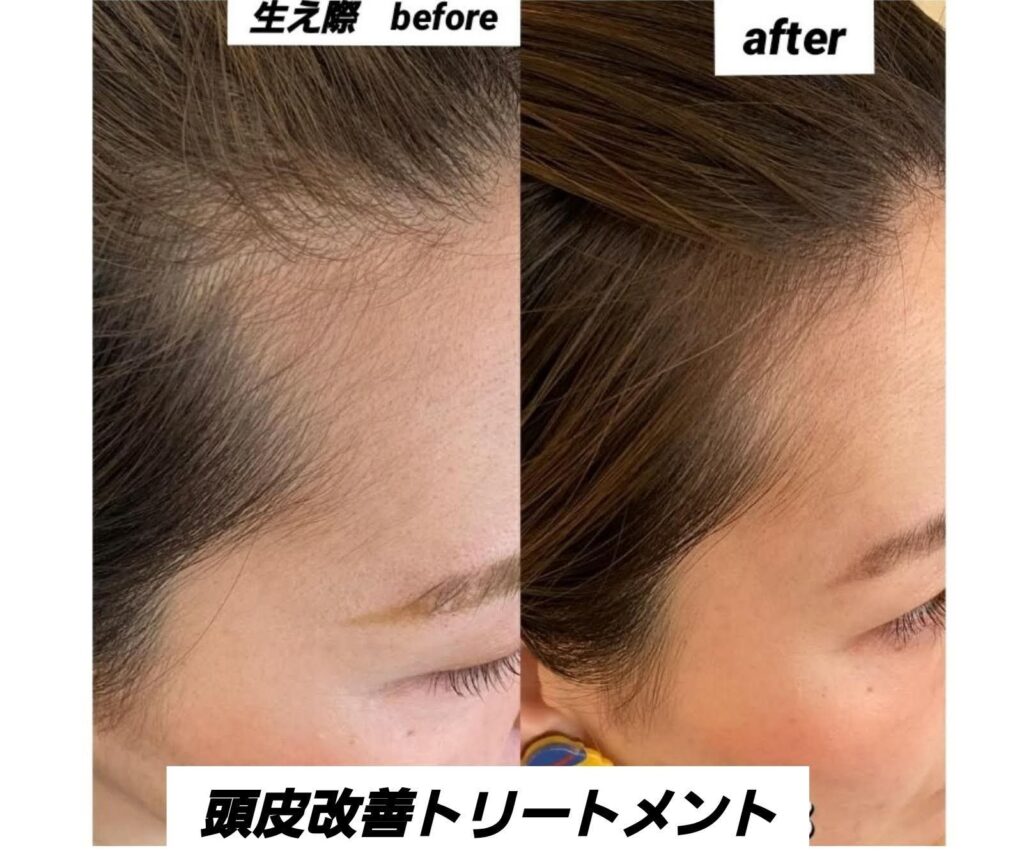 薄毛　細毛も治る改善出来よるように、ソアリスではなって来て…