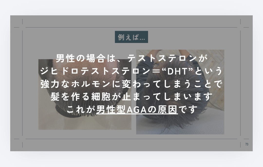  例えば…男性の場合は、テストステロンが、ジヒドロテストステロン＝“DHT”という強力なホルモンに変わってしまうことで、髪を作る細胞が止まってしまいますこれが男性型AGAの原因です